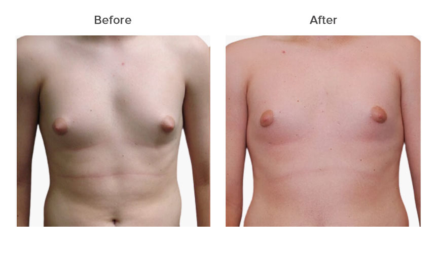 gynecomastia surgery in India