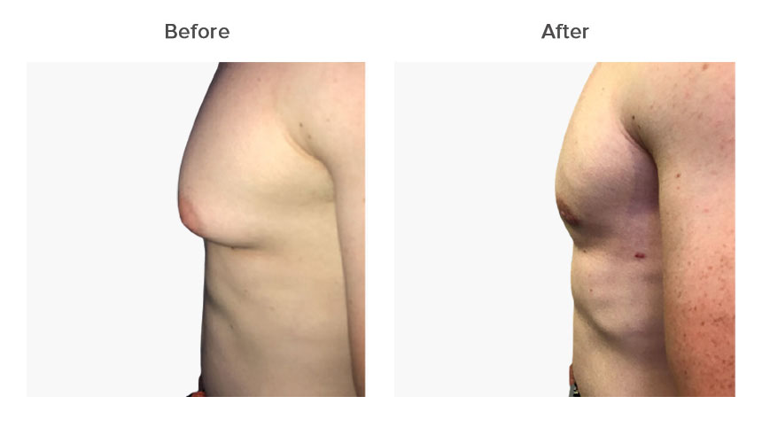 gynecomastia in Delhi