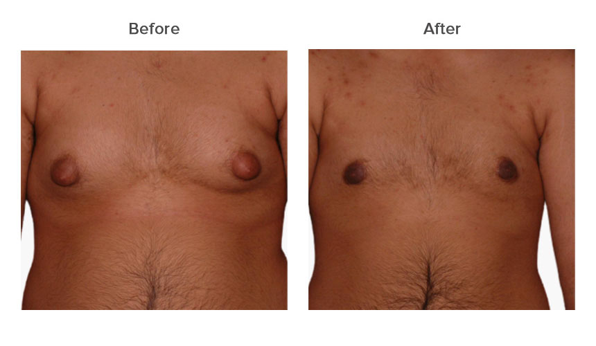 gynecomastia in India