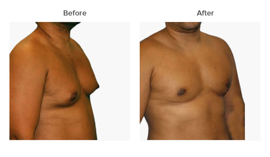 gynecomastia surgery in Delhi